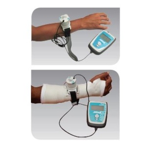 Melmak Fracture Healing System