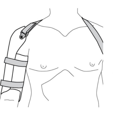 Ossur Humeral Cast Brace