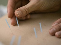 Acupuncture Needles & Supplies