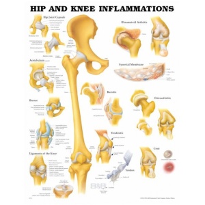 Hip and Knee Inflammations