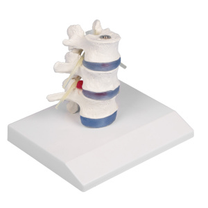 Lumbar Vertebrae with prolapsed inter vertebral discs with stand