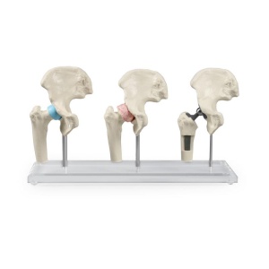 Hip-Implant-Model