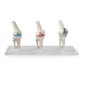 Knee-Implant-Model