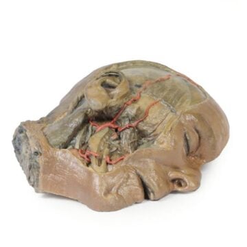 Sagittal Section of head with infratemporal Fossa Dissection