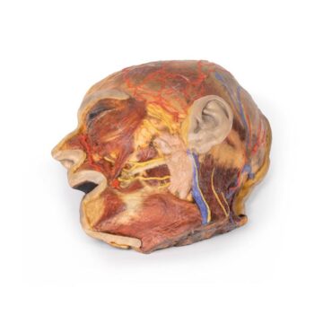 Superficial Facial nerves & Parotid Gland