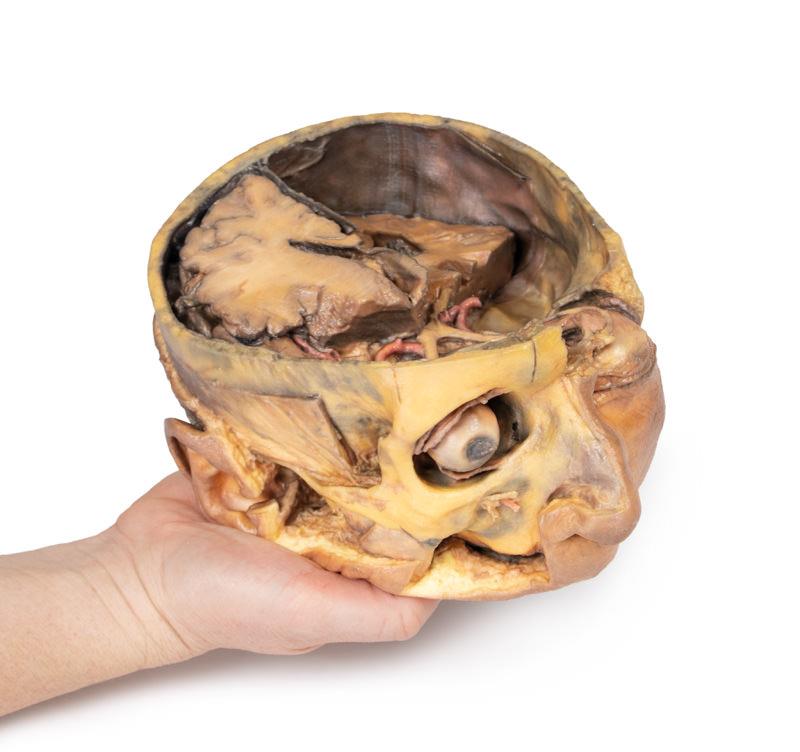 Transverse Section of the head - 5