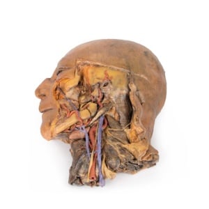 Sagittal Section of Head and Neck with Infratemporal Fossa and Carotid Sheath Dissection