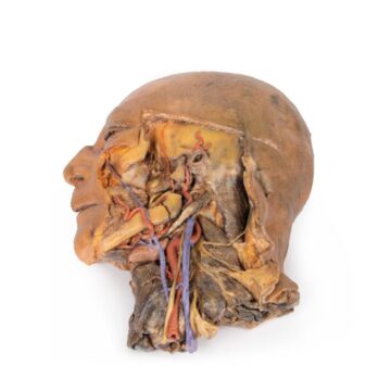 Sagittal Section of Head and Neck with Infratemporal Fossa and Carotid Sheath Dissection