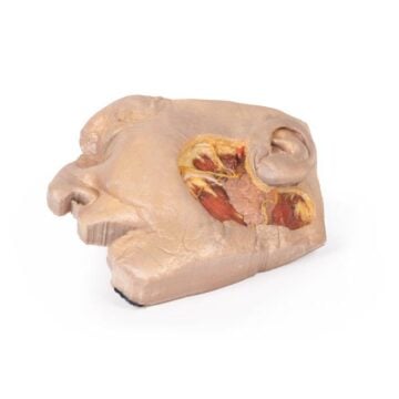 Parotid Gland and Facial Nerve dissection