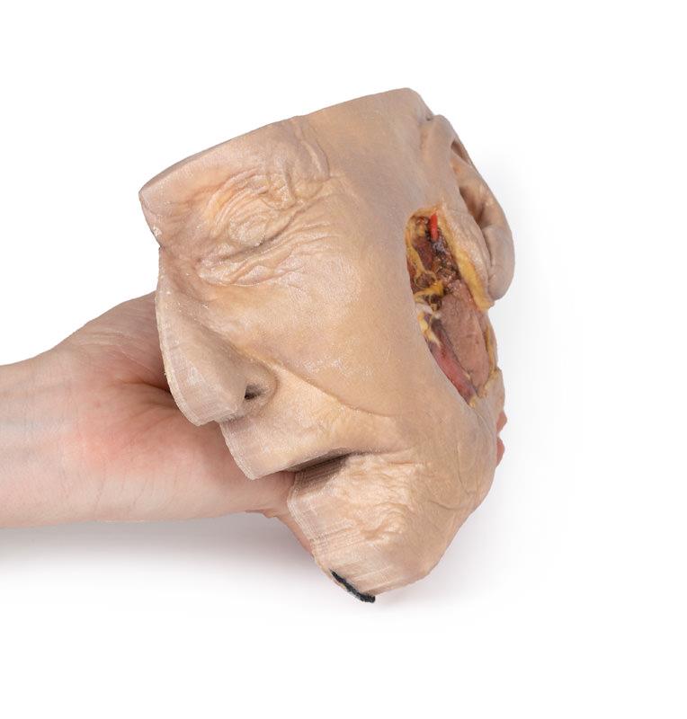 Parotid Gland and Facial Nerve dissection - 4