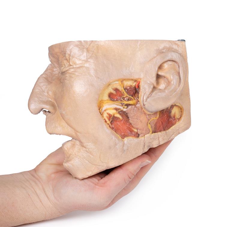 Parotid Gland and Facial Nerve dissection - 5