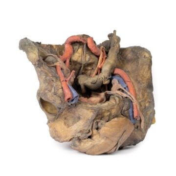 Female pelvis deep dissection