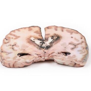 Glioma grade 3-4, causing papilloedema