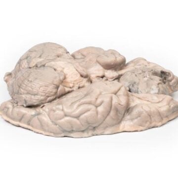 Meningioma