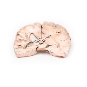 Left cerebral infarct