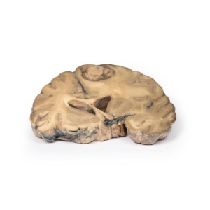 Metastatic Adenocarcinoma in the Brain