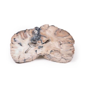 Cerebral Arterio-Venous Malformation
