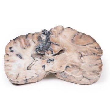 Cerebral Arterio-Venous Malformation