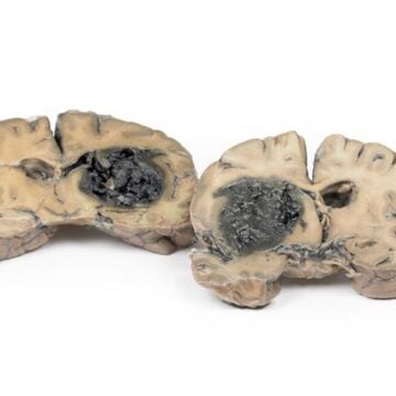 Intracerebral Haemorrhage