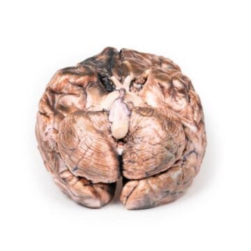 Ruptured Berry Aneurysm