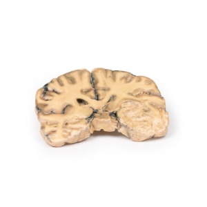 Astrocytoma