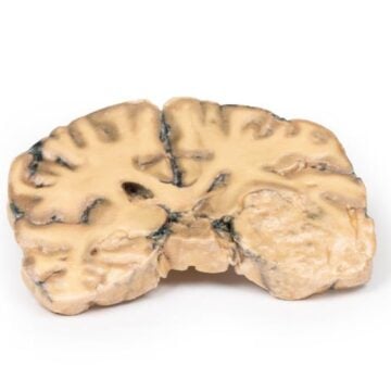 Astrocytoma