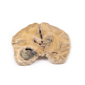 Glioblastoma multiforme