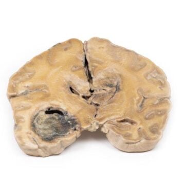 Glioblastoma multiforme