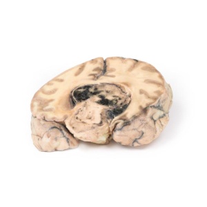 Glioblastoma multiforme