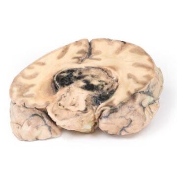 Glioblastoma multiforme