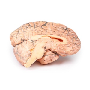 Craniopharyngioma