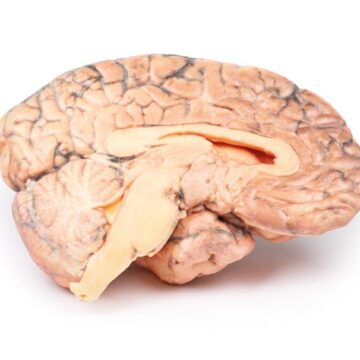 Craniopharyngioma