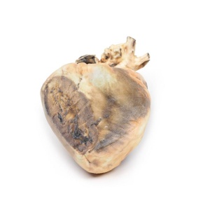 Atrial septal defect