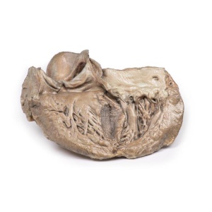 Bicuspid Aortic Valve