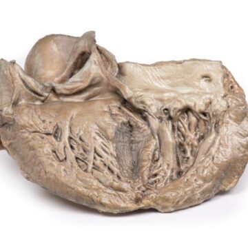 Bicuspid Aortic Valve