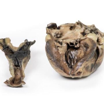 Hydatid Disease Affecting the Heart and Aorta
