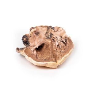 Rheumatic endocarditis