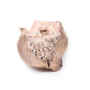Acute Bacterial Endocarditis