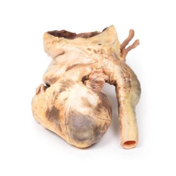 Syphilitic Aneurysm