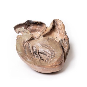 Ruptured Thoracic Aortic Aneurysm