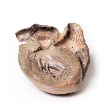 Ruptured Thoracic Aortic Aneurysm