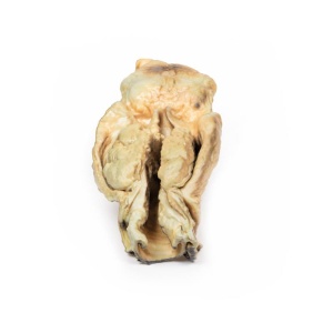 Carcinoma of Larynx