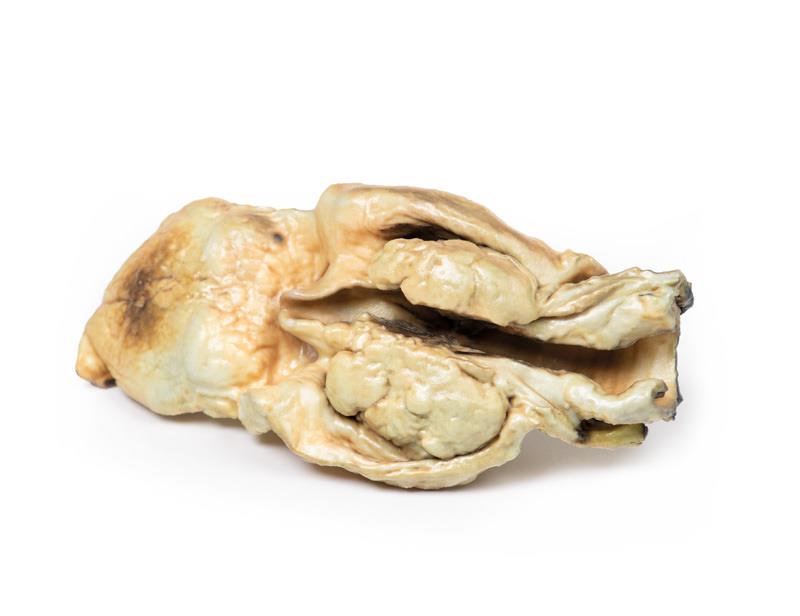 Carcinoma of Larynx - 3