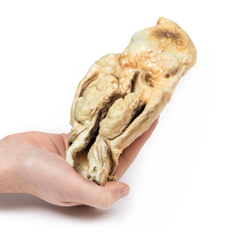 Carcinoma of Larynx - 4