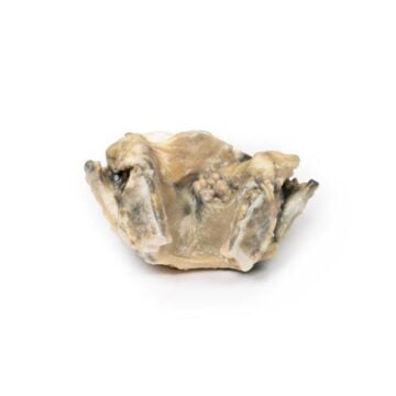 Carcinoma of Larynx