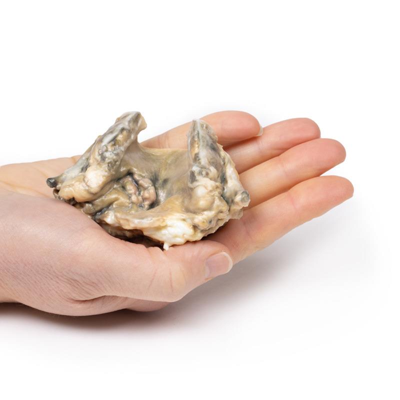 Carcinoma of Larynx - 3