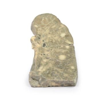 Metastatic carcinoma