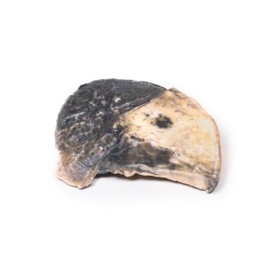 Lobar pneumonia
