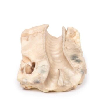 Trachea Hodgkin Lymphoma