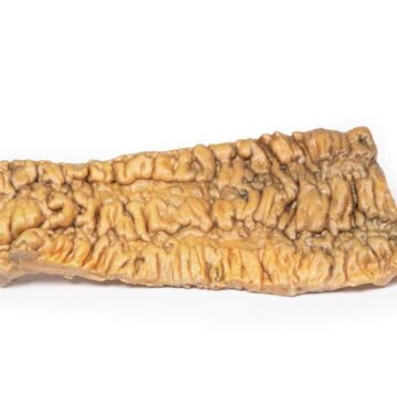 Ulcerative Colitis